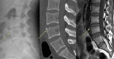limbus vertebrae